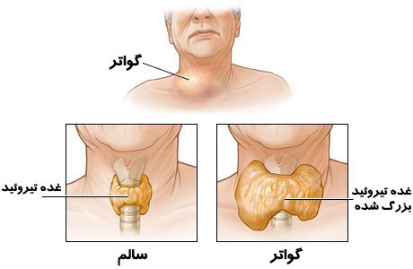 Goiter
