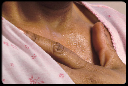 menopause_s7_heat_flashes