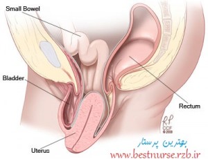 obgyn-uterine-prolapse