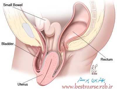 obgyn-uterine-prolapse